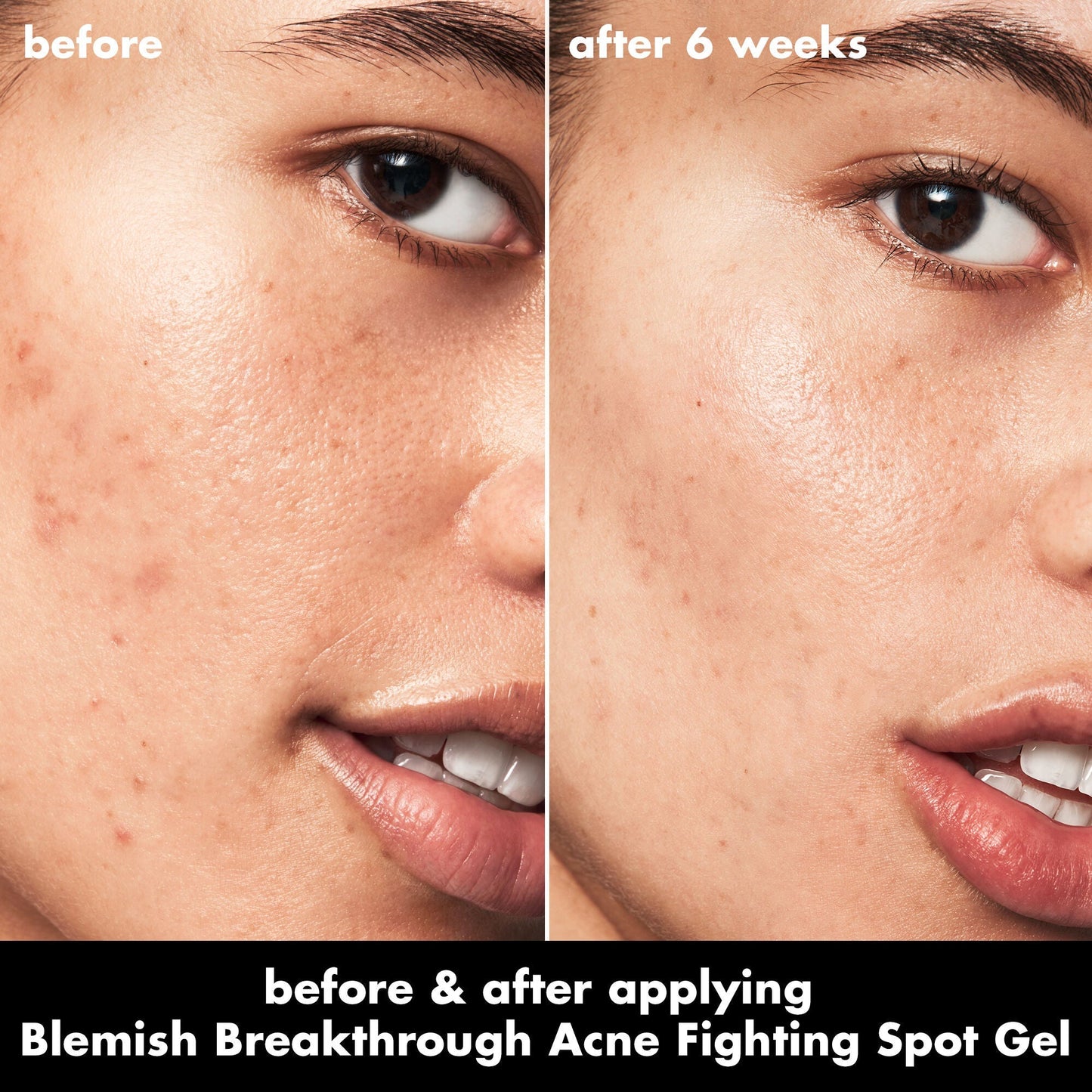 blemish-breakthrough-acne-fighting-spot-gel-u7 0326_EDU_BB_SpotGel_BA_ISABELLA.jpg