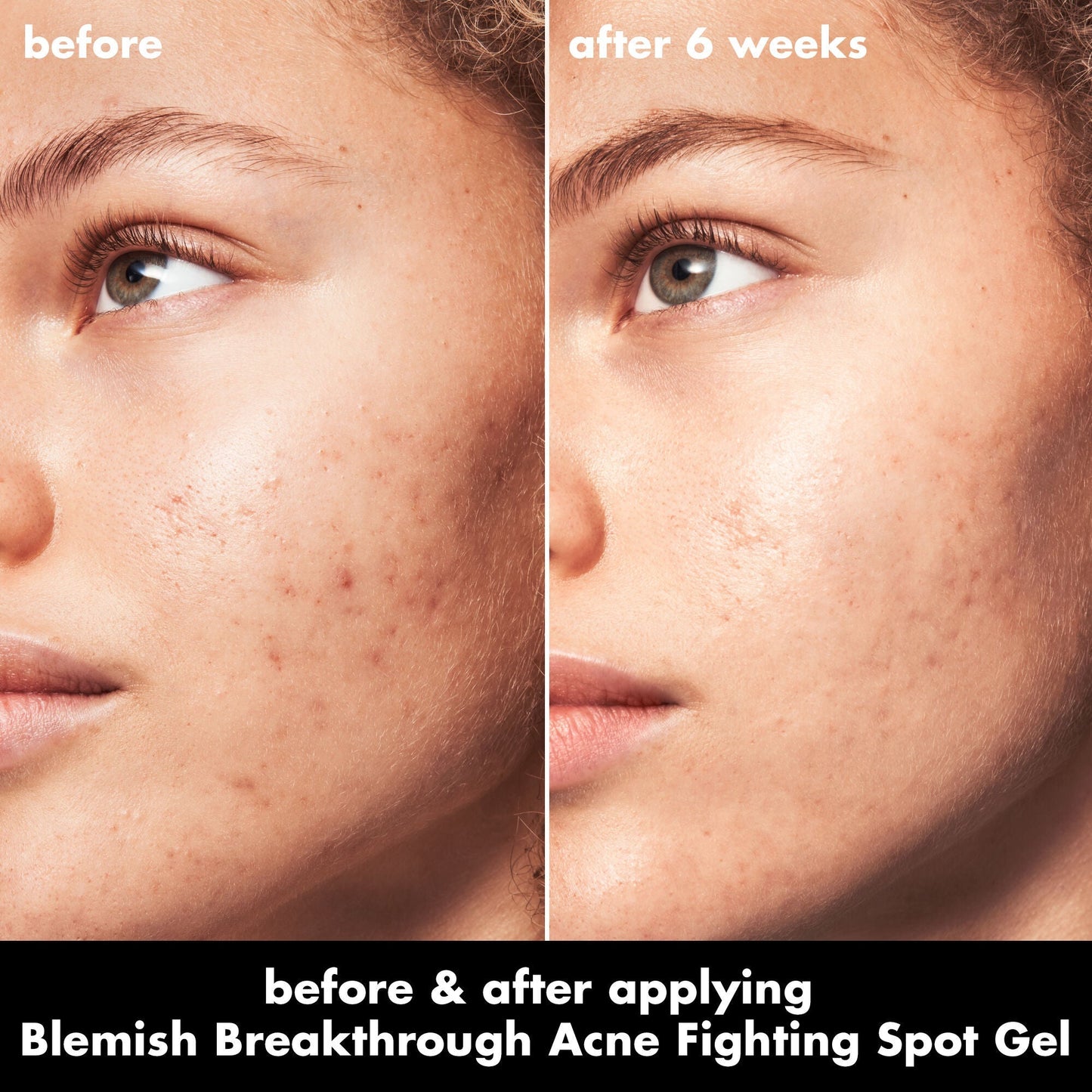 blemish-breakthrough-acne-fighting-spot-gel-u7 0326_EDU_BB_SpotGel_BA_MARLEY.jpg