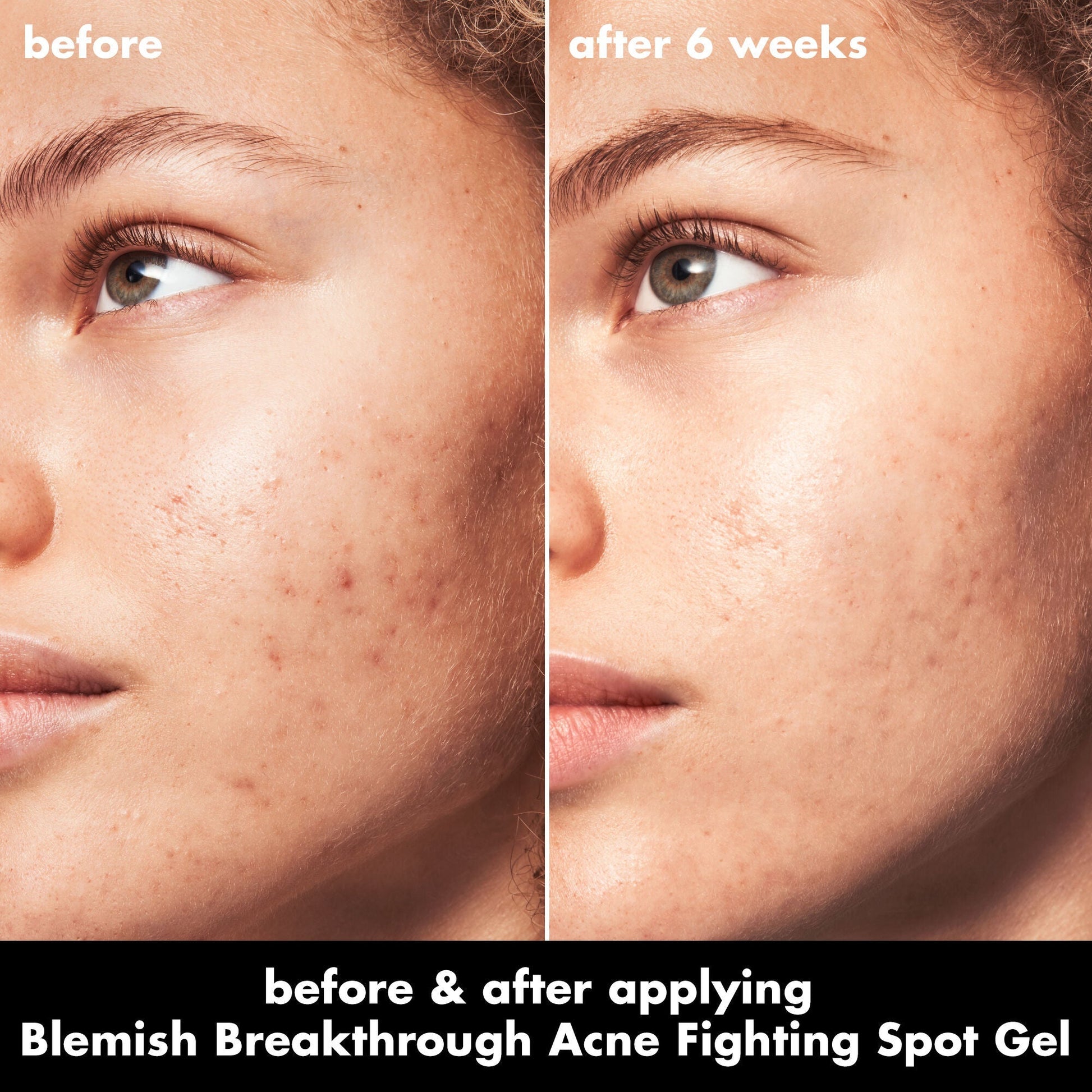 blemish-breakthrough-acne-fighting-spot-gel-u7 0326_EDU_BB_SpotGel_BA_MARLEY.jpg