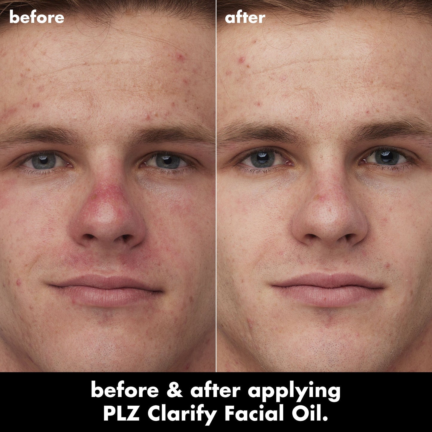 plz-clarify-facial-oil-u5 0326_EDU_PlzClarify_BA_Caleb.jpg