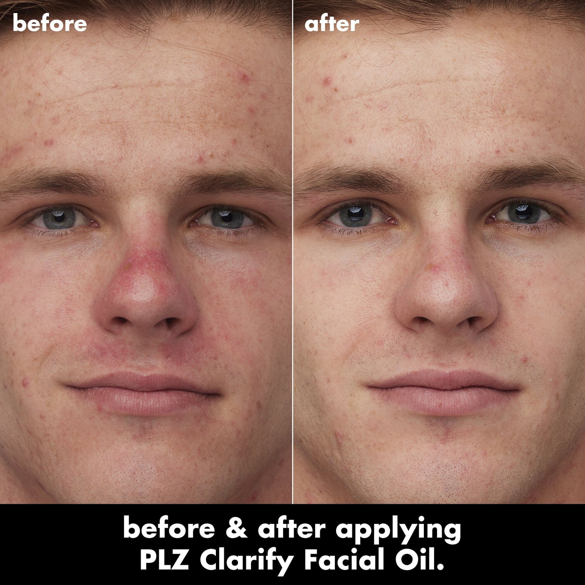 plz-clarify-facial-oil-u5 0326_EDU_PlzClarify_BA_Caleb.jpg