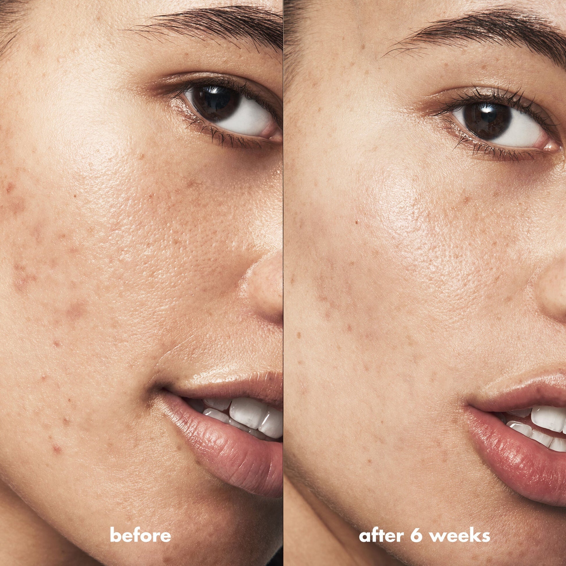 blemish-breakthrough-acne-clarifying-cleanser-e6 Acne_PDP_Isabella_Before_After_a3ff322b-cc6f-4b1a-9db3-bfb66c15d034.jpg