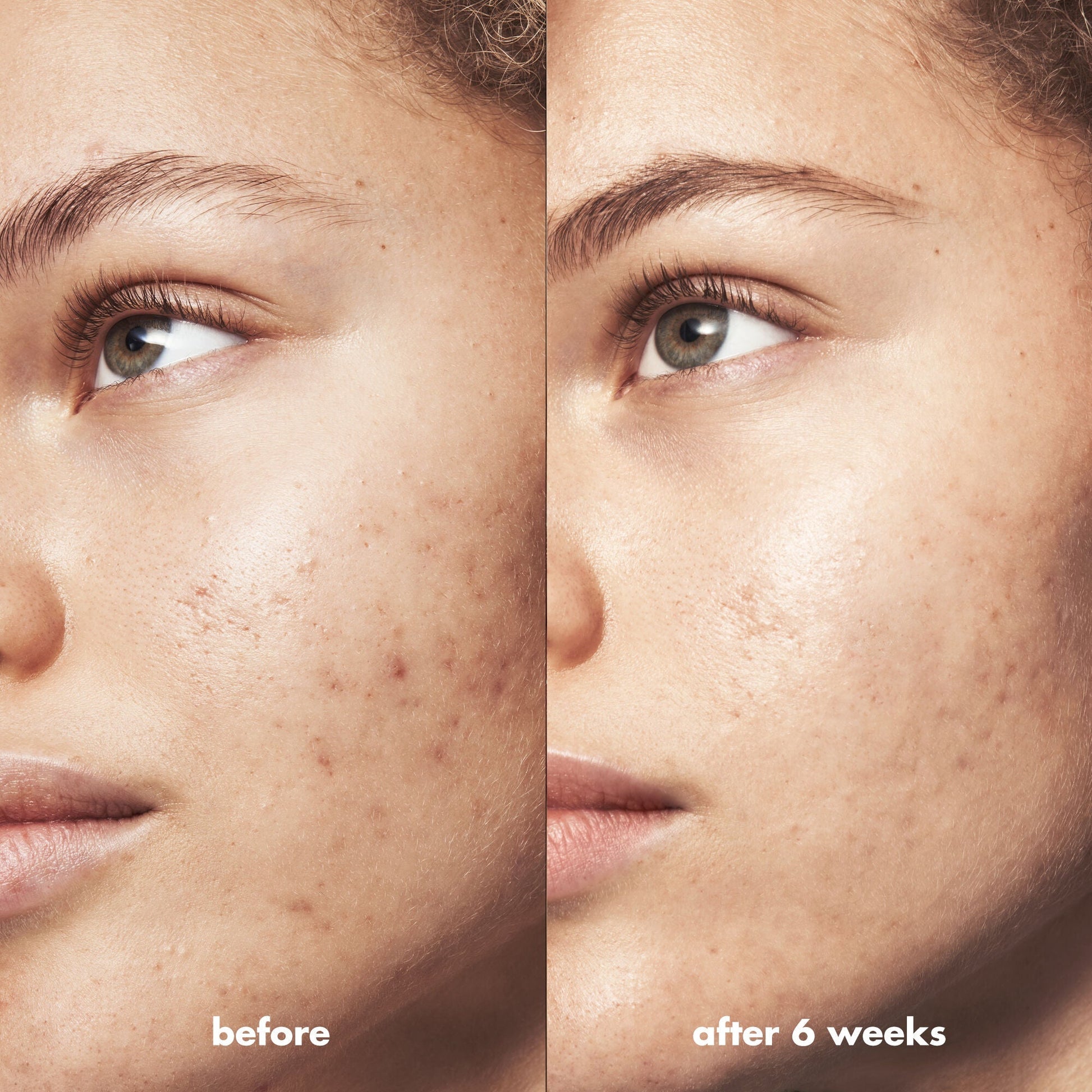 blemish-breakthrough-triple-acid-resurfacing-serum-q1 Acne_PDP_Marley_Before_After_1a95cac5-0af6-43b6-a936-d0bacbdec0bf.jpg